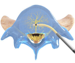 Procedure Details - The Intracept Procedure By Relievant