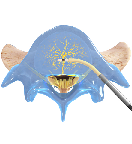 Intracept Basics - The Intracept Procedure By Relievant