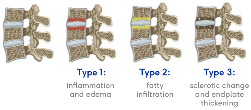 Modic Changes The Intracept Procedure By Relievant